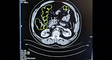 Mide ve bağırsaklarında uyuşturucu taşıyan 3 İranlı yakalandı