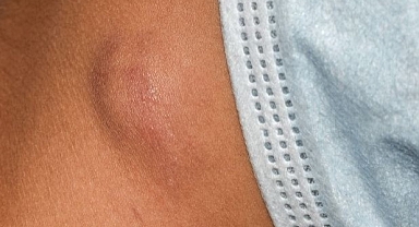 Çocuklarda lenf bezi büyümesinin işaretlerine dikkat!