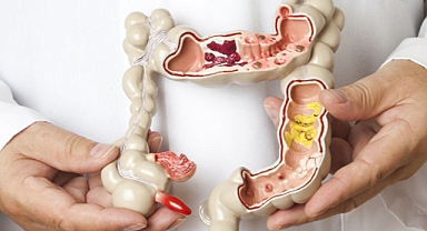 Kolon kanseri bu yöntemle önlenebiliyor