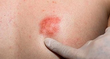 Zona her 3 kişiden birinin hayatını etkiliyor