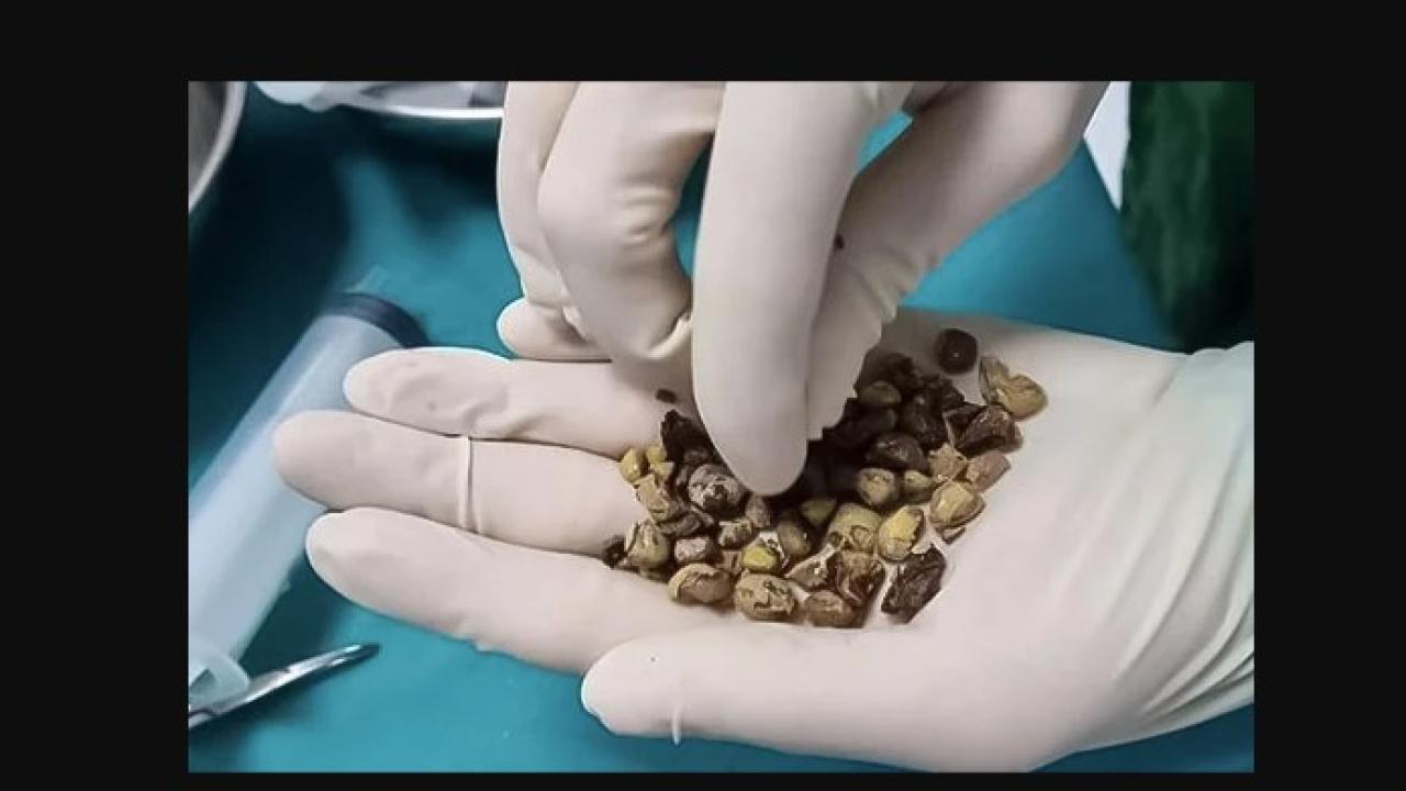 böbrek taşında doğru sanılan 10 tehlikeli bilgi