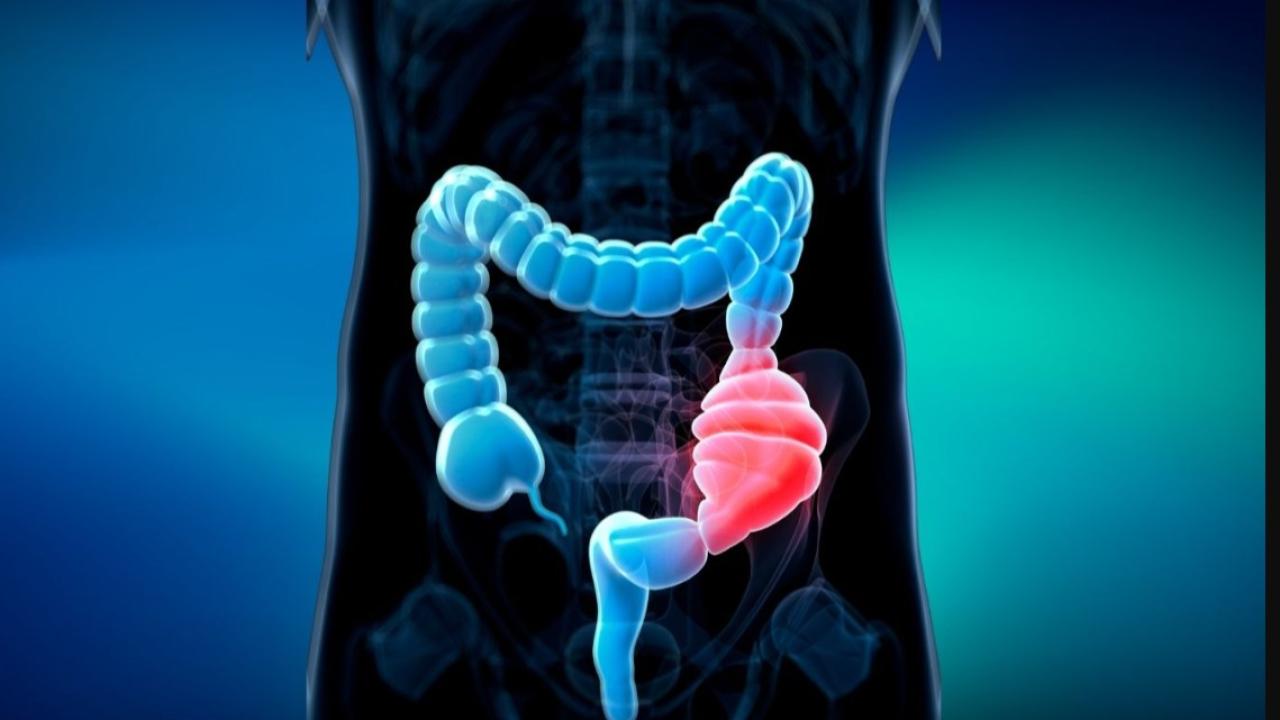 Kolon kanseri riskini artıran bu faktörlere dikkat