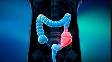 Kolon kanseri riskini artıran bu faktörlere dikkat