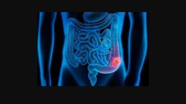 Kolon kanserinde yaş sınırı giderek düşüyor