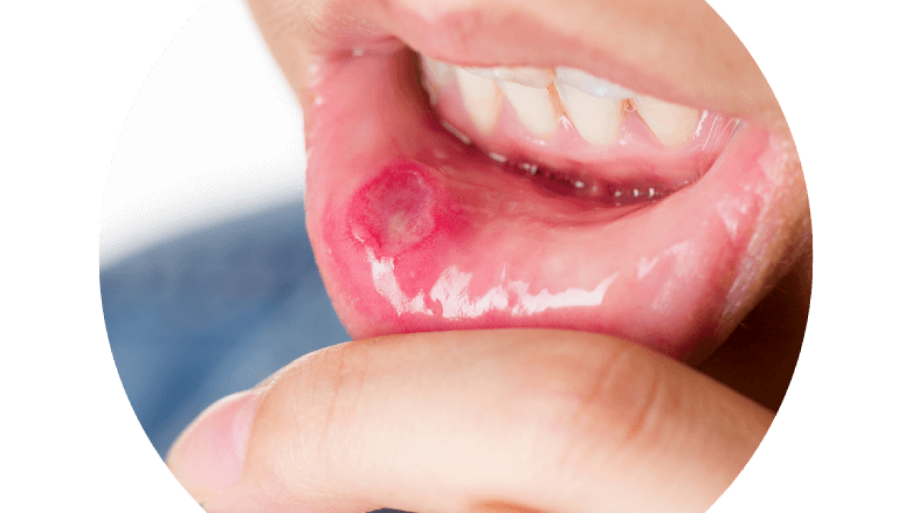 Ağız içinde geçmeyen yaraları hafife almayın