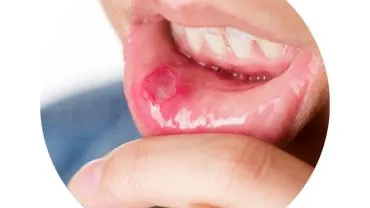 Ağız içinde geçmeyen yaraları hafife almayın