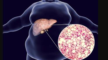 Karaciğer yağlanması siroz ve kanser riskini artırabilir